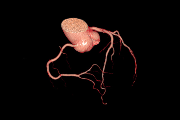 CT-Coronary-Angiography