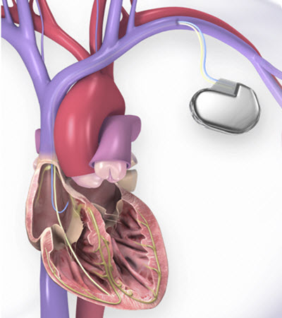 Cardiac Defibrillator Implantation