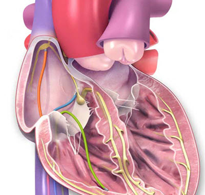 Catheter Ablation