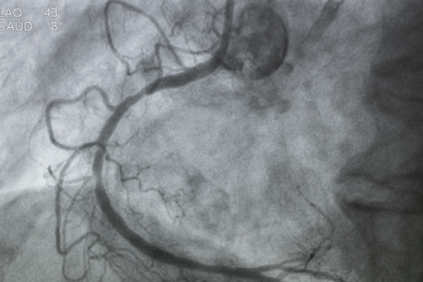 Coronary Angiography