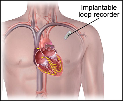 Implantable Loop Recorder