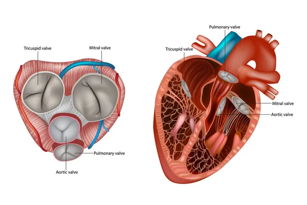 Mitral Balloon Valvuloplasty