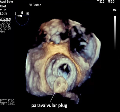 Paravalvular Leak Closure