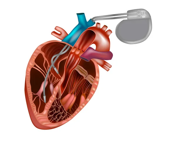 Pacemaker implantation