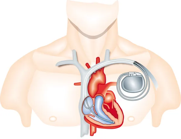 Pacemaker monitoring