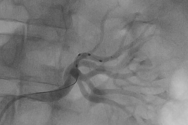 Renal-Artery-Denervation 