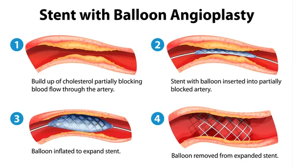 Stenting