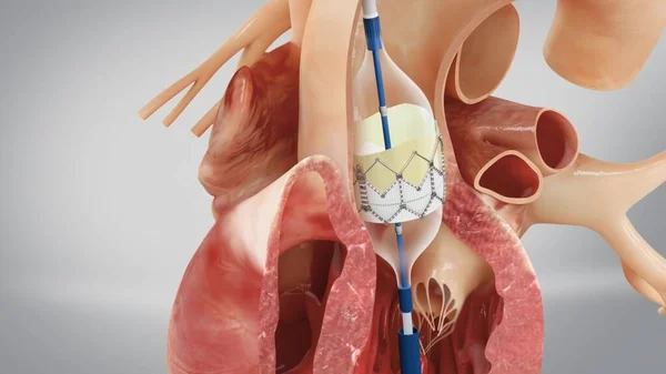 Transcatheter Aortic Valve Implantation