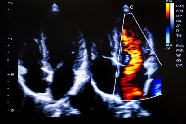 echocardiography