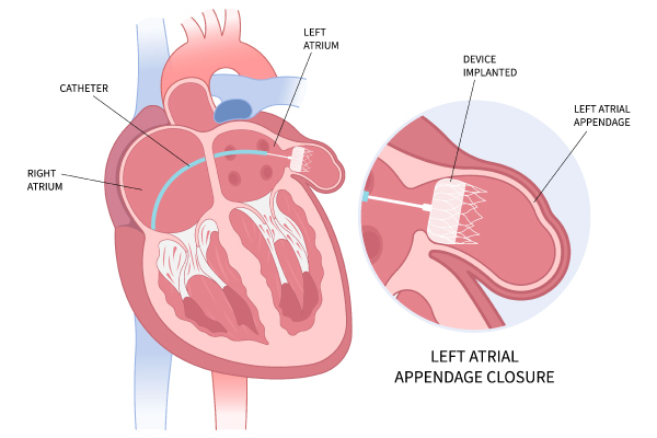 Left Atrial Appendage Closure